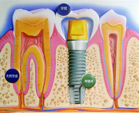 种植牙手术前6个须知|牙科种植|陕西嘉友科贸有限公司