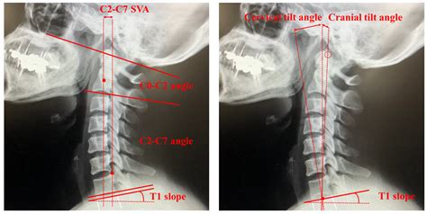 Current Concepts of Cervical Spine Alignment, Sagittal Deformity, and Cervical Spine Surgery