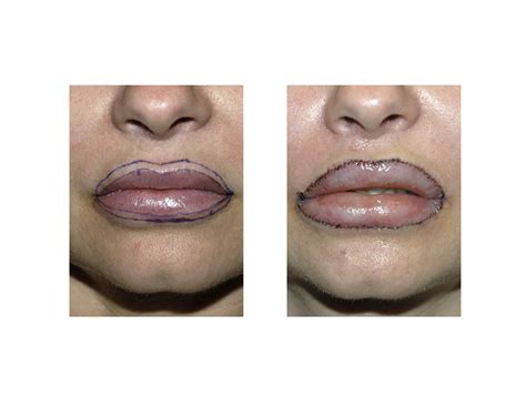 Case Study: Upper and Lower Lip Vermilion Advancements for Injectable ...