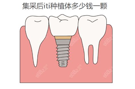 iti和诺贝尔种植体的区别是：适应症不同/价格不同/型号不同 - 口腔资讯 - 牙齿矫正网