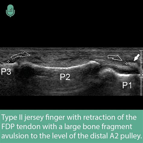 Image result for Leddy Packer Classification Table
