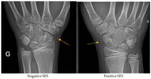 Scaphoid Fractures In Children