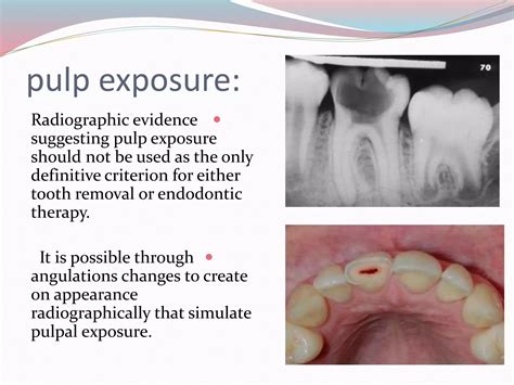 Dental common disease on x-ray | by Dr.mohammad nameer | PPTX