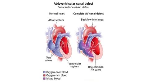 Atrioventricular Canal Defect (Endocardial Cushion Defect)