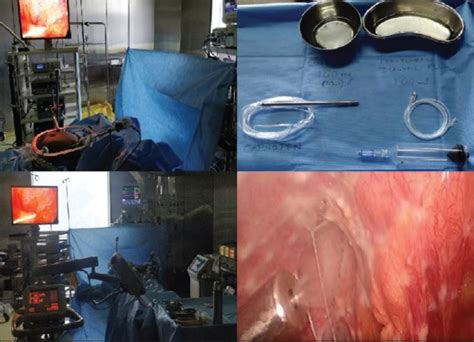 Image result for Intraperitoneal Therapy