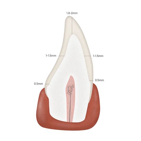 Zirconia Crowns Preparation Why Dentists Love BruxZir Solid Zirconia