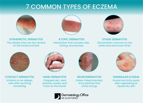 Adult Eczema Symptoms