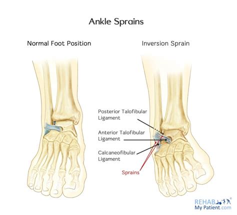 Inversion Sprain of the Ankle | Rehab My Patient