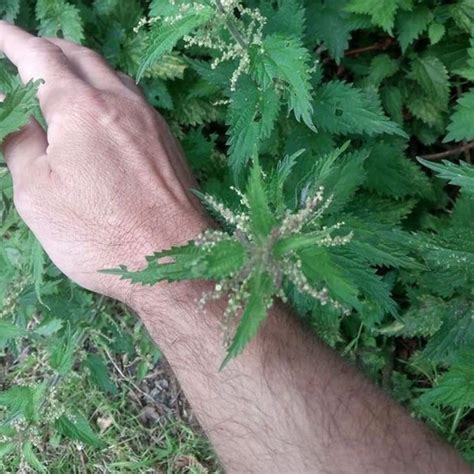 How To Get Rid Of A Nettle Sting at Aidan Penton blog