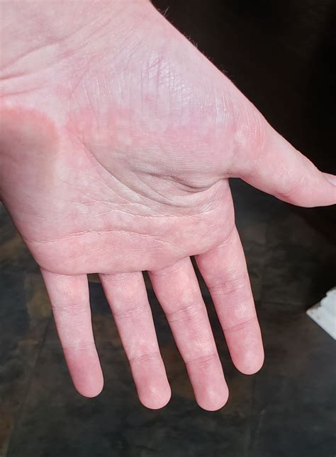 Palms get red and spotty when I have them down at my sides... is this blood pooling or something ...