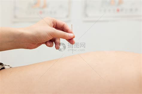 患者背部做针灸高清图片下载-正版图片501808892-摄图网