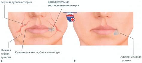 Методика инъекции наполнителей (филлеров) для подъема уголков рта
