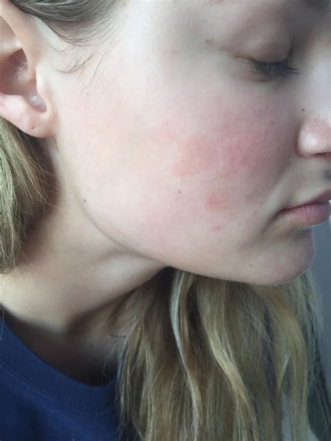 Random red patches on face?? – Rosacea & facial redness – Acne.org Forum