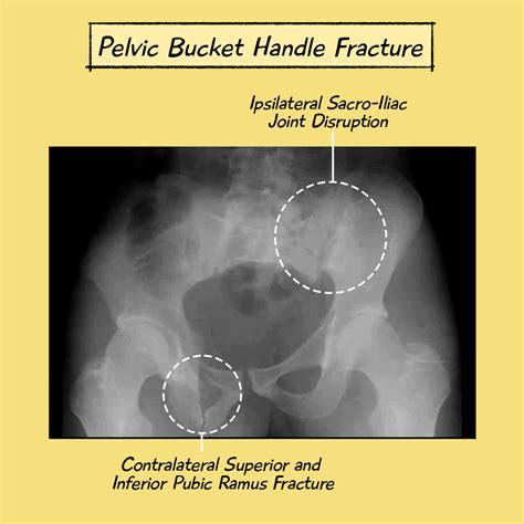Pelvic Fracture: In-Depth Overview for Students (With PPT)