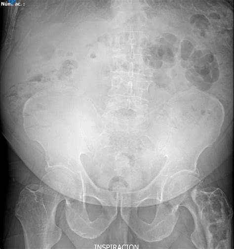 Normal Abdominal X Ray Gasless Abdomen In The Adult: What Does It