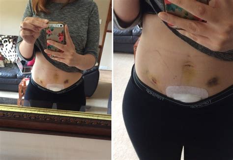 Pin on Health - Endometriosis
