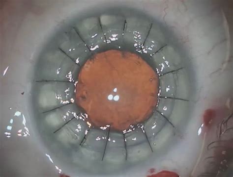 Successful transplant with 3D surgery by removing cataracts from the ...