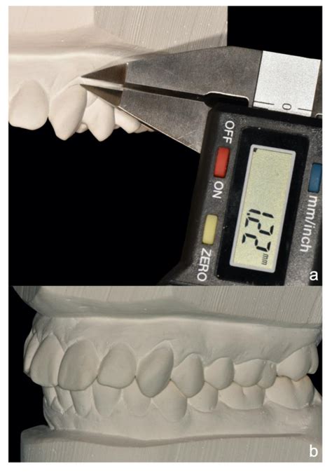 The Impact of Orthodontic Treatment on Pre-Existing Gingival Recessions ...