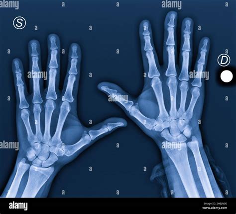Osteoarthritis Hand Xray