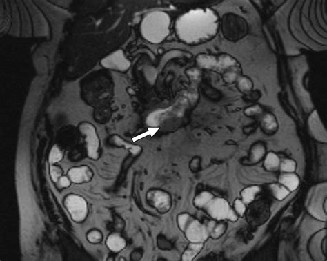 Duodenal Abnormalities at MR Small-Bowel Follow-Through | AJR