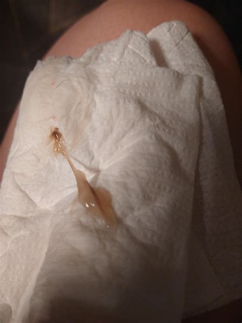 I'm two weeks away from my period and on Nexplanon, but I'm having ...