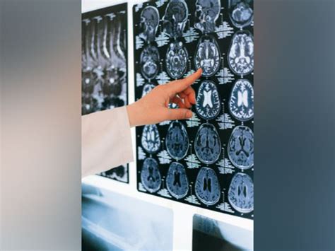 Study shows epilepsy brain implant does not transform patients' personality