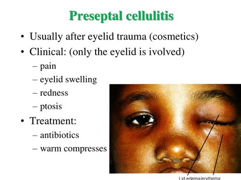 Does cellulitis ooze. Cellulitis: Causes, Symptoms, and Treatment of ...