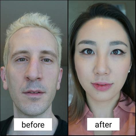 To Fix Deviated Septum Surgery