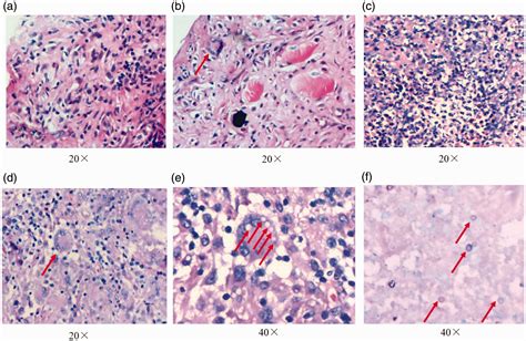 Cryptococcal infection of the femur misdiagnosed as a primary bone ...