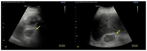 Multimodality Imaging Findings in Waterhouse-Friderichsen Syndrome: A ...