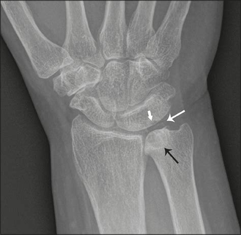 SciELO Brasil - Lunotriquetral coalition and ulnar impaction syndrome: a pictorial essay ...