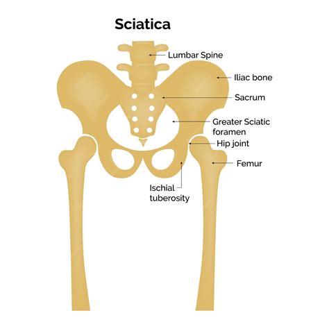 Premium Vector | Sciatica Lumbar Spine Iliac bone Sacrum Greater ...
