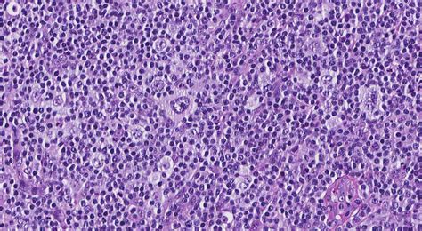 Su informe patológico del linfoma de Hodgkin clásico – MyPathologyReport