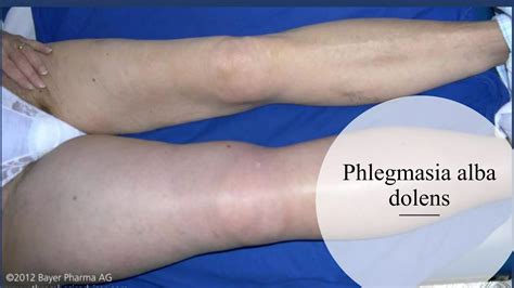 Varicose Veins and Deep Vein Thrombosis | PPTX