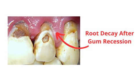 4 Common Things That Happen When Gums Start to Recede