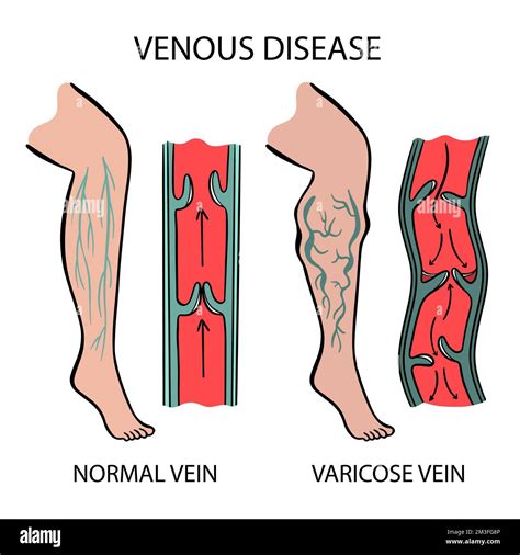 Varicose veins in legs hi-res stock photography and images - Alamy