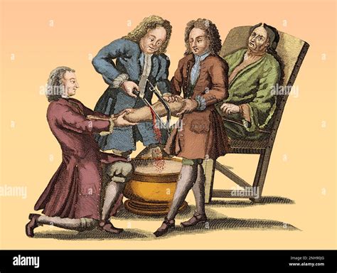Medicine surgery amputation leg amputation hi-res stock photography and images - Alamy