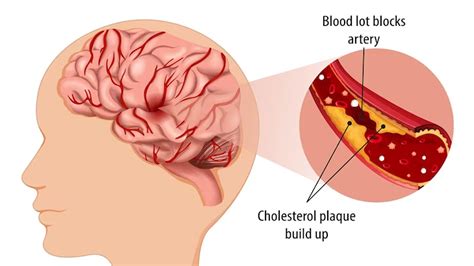 What Are The Symptoms Of Clot In Brain at Marion Akers blog