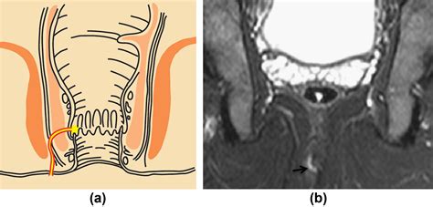 MRI of perianal fistulae: a pictorial kaleidoscope - Clinical Radiology