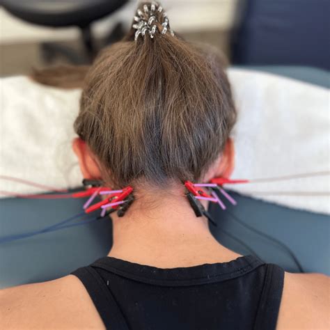 Orlando Dry Needling | Pursuit Physical Therapy