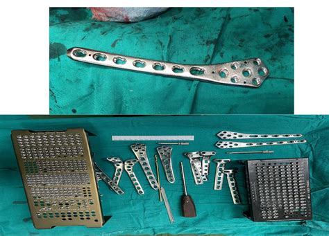 Comparative study of functional outcome in single plating and dual ...