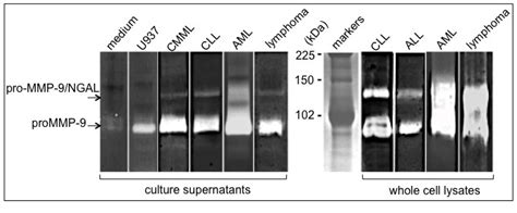 Neutrophil Gelatinase-Associated Lipocalin (NGAL), Pro-Matrix ...