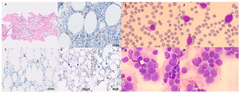 Spontaneous Remission of Blastic Plasmacytoid Dendritic Cell Neoplasm ...