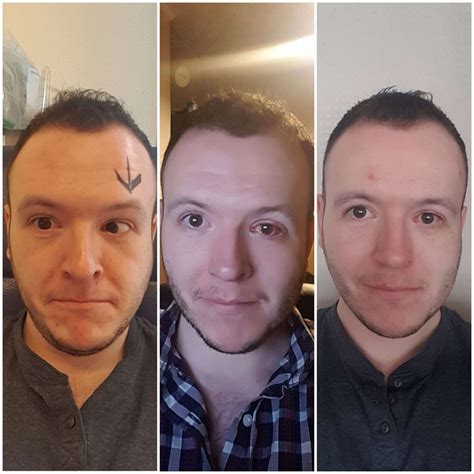 This Man's Photos Capture How Lazy Eye Surgery Changed His Life