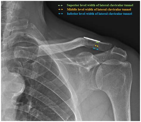 Progressive Loss of Acromioclavicular Joint Reduction Correlated with ...