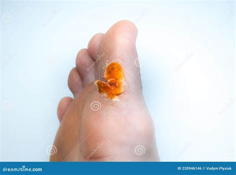Contagious Skin Illness on Foot. Medical Treatment Photo..Close Up Photo of Plantar Wart on Man ...