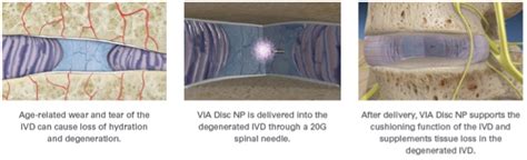 Image result for Via Disc Procedure