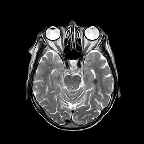 Head Mri With Contrast