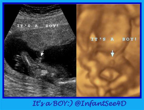 Baby Boy Ultrasound 13 Weeks at Aurora Mcdonald blog