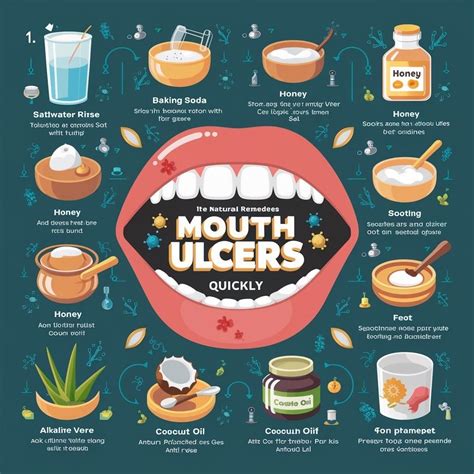 Ulcers in mouth – Artofit